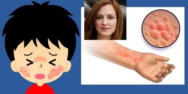 Какво е нервна уртикария?