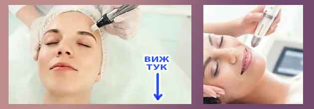 Странични ефекти от мезотерапия. Мнения. За лице и коса 6 Stranichni Efekti Ot Mezoterapia Mesotherapy 03