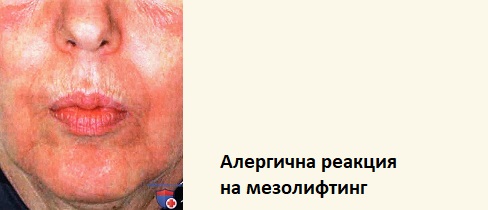 Странични ефекти от мезотерапия. Мнения. За лице и коса 7 Мезотерапия странични ефекти 03