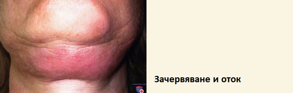 Странични ефекти от мезотерапия. Мнения. За лице и коса 2 Мезотерапия странични ефекти 04