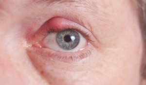 Ечемик на окото – отстранете го бързо и лесно с народна медицина 3 Echemik-na-okoto-300x175